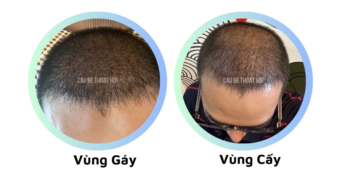 sau cấy tóc chữa hói thành công 23 hôm cậu bé thoát hói bằng công nghệ cấy tóc DHI