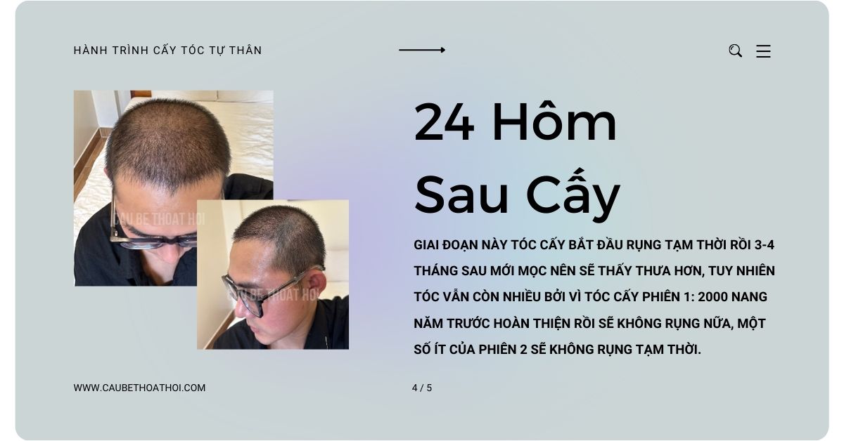 sau cấy tóc chữa hói thành công 24 hôm cậu bé thoát hói bằng công nghệ cấy tóc DHI