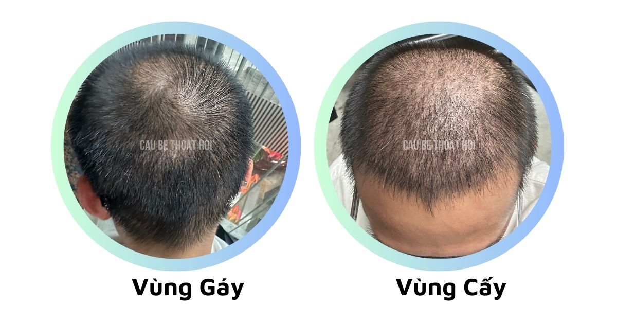 sau cấy tóc chữa hói thành công 26 hôm cậu bé thoát hói bằng công nghệ cấy tóc DHI