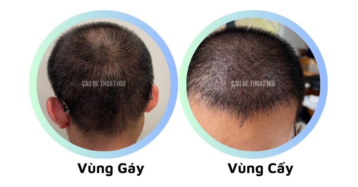 sau cấy tóc chữa hói thành công 28 hôm cậu bé thoát hói bằng công nghệ cấy tóc DHI
