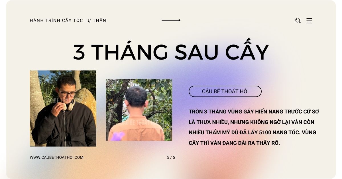 sau 3 tháng cấy tóc tự thân chữa hói bằng công nghệ cấy tóc DHI của cậu bé thoát hói