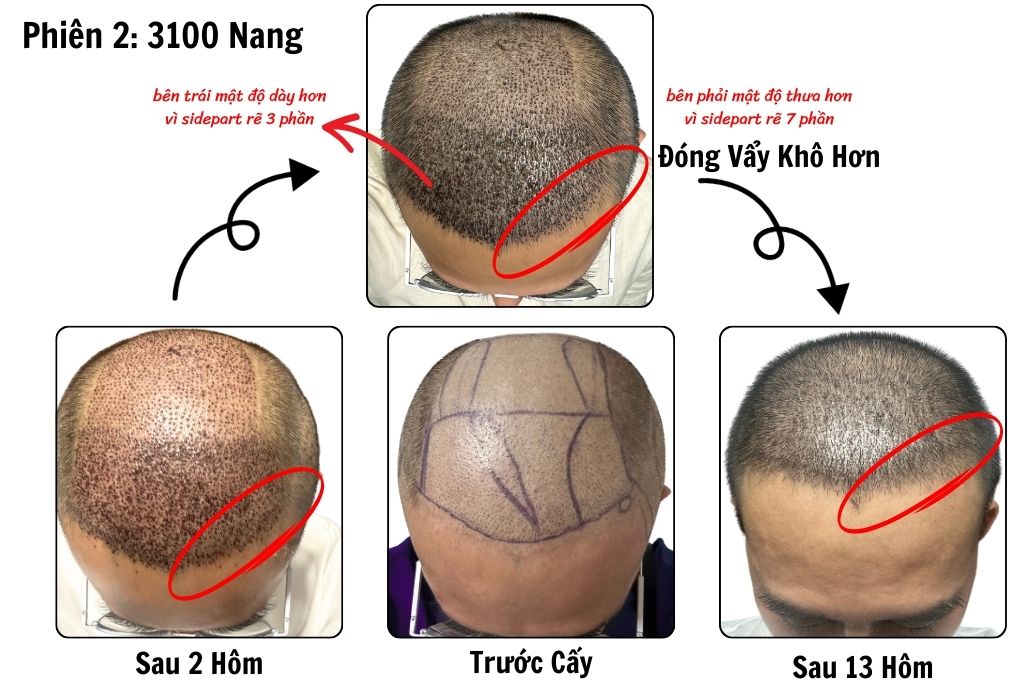 SỰ PHÂN BỔ TỐI ƯU KHI ĐI CẤY TÓC TRỊ HÓI BẰNG CÔNG NGHỆ DHI CỦA TRUNG TÂM CẤY TÓC UY TÍN