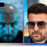 Cầu Thủ Adrian Mutu Cấy Tóc Và Kết Quả Thành Công