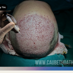 Cấy Tóc Tự Thân Thì Cần Bao Nhiêu Nang Tóc