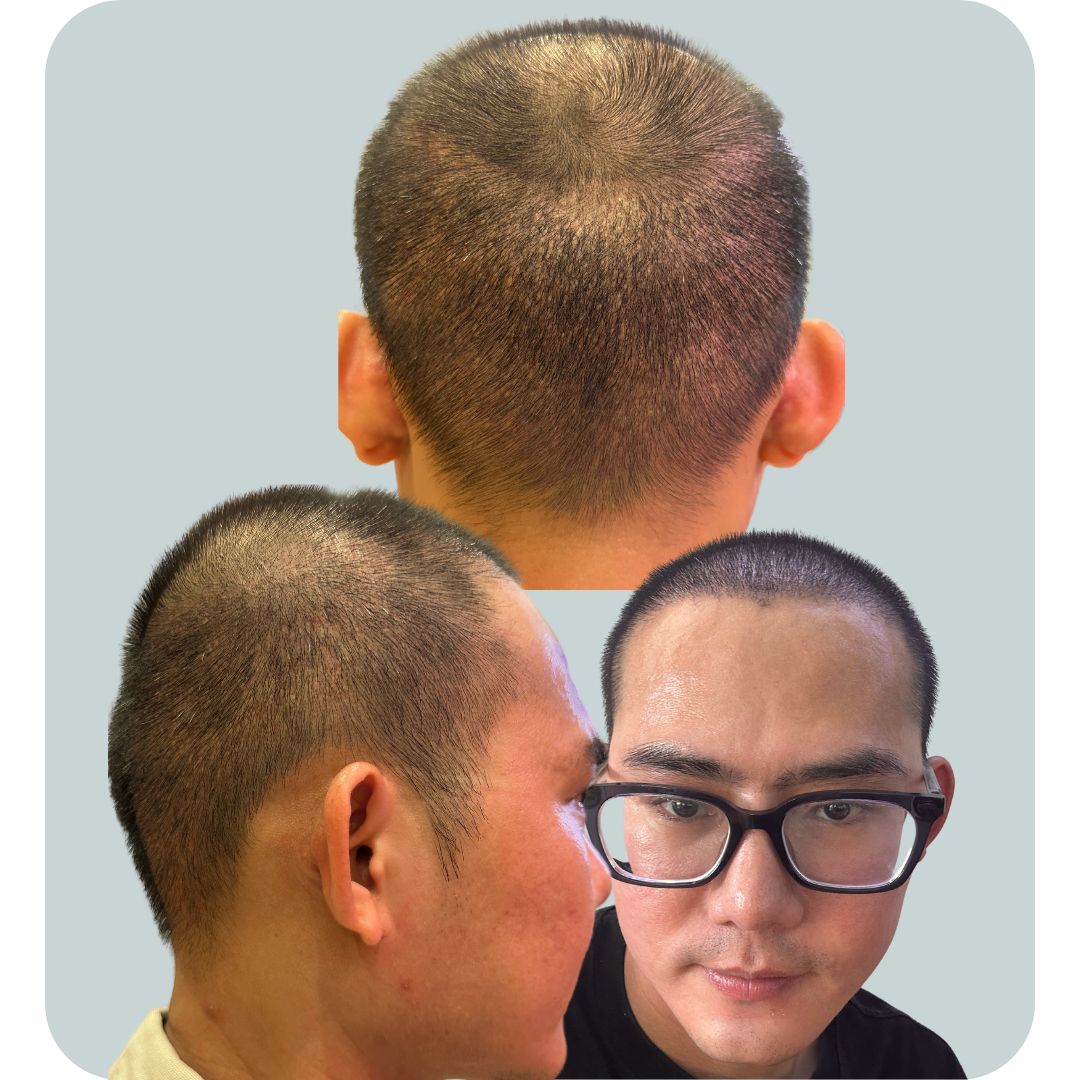 Vùng Gáy Hiến Nang Cấy Tóc Sau 17 Hôm Hiện Tại Đã Phủ Lên. Vùng Gáy Rất Nhanh Lành Thương Chỉ Cần 5-8 Hôm Sau Cấy Là Bong Mài Kéo Da Non Rồi. 17 Hôm cấy tóc DHI Thì Cảm Nhận Rất Thoải Mái.