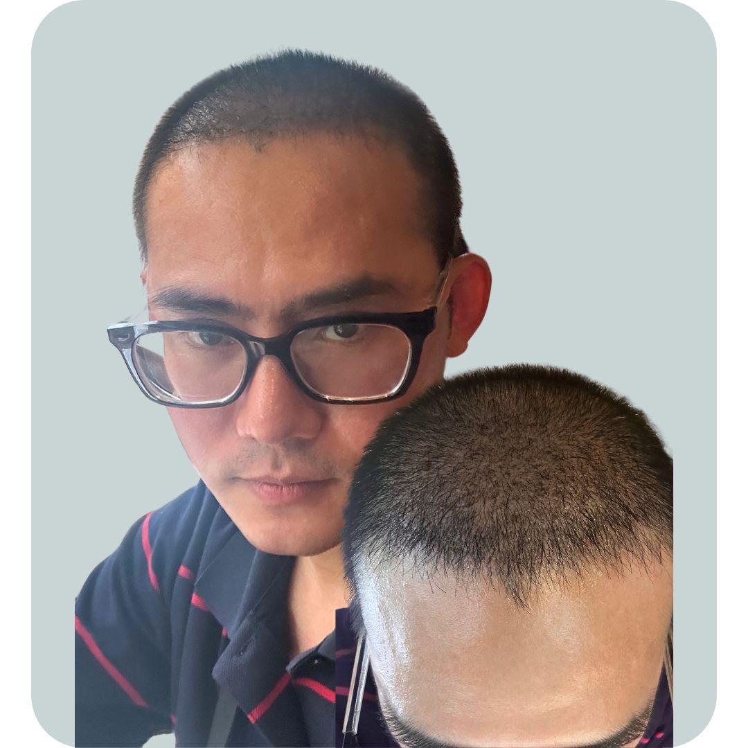 Vùng Cấy Tóc Lúc Này Được 23 Hôm, Hơi Thấy Rụng Tạm Thời Từ Lúc Gội Đầu Hay Trong Sinh Hoạt Bình Thường