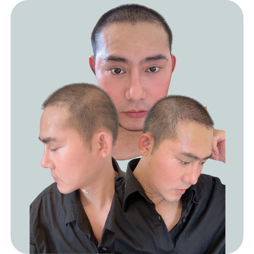 4 Hôm Mình Soi Thấy Tóc Cấy Rụng Tạm Thời Nhiều Hơn Tí Rồi. Thông Thường Có Bạn Không Rụng Nhiều, Nhưng Có Người Lại Rụng Đến 80-90% Tóc Cấy. Và Đây Là Tình Trạng Bắt Buộc Diễn Ra Sau Cấy Tóc Tự Thân Công nghệ DHI.