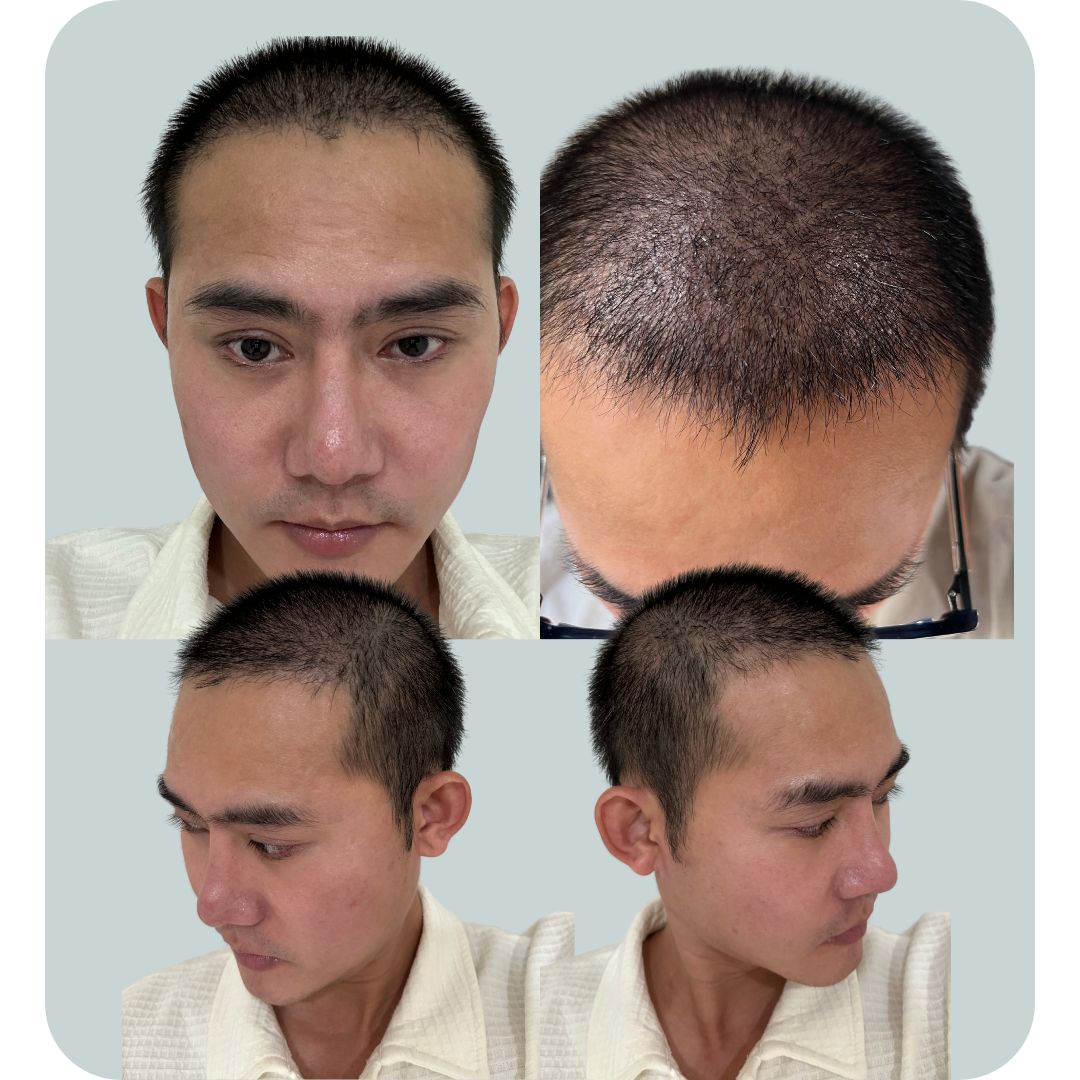 Giai Đoạn Sau 1 Tháng Cấy Tóc Chữa Hói Của Mình: Tóc Cấy Phiên 1 (2000 Nang) Vẫn Nằm Đó Sau 1 Năm 1 Tháng Cạo Để Cấy Phiên 2 Giờ Mọc Lên Bình Thường. Còn Tóc Phiên 2 (3100 Nang) Thì Đang Phát Triển Lúc Này Nằm Xiên Quẹo Không Ngay Ngắn Như Lúc Mới Bong Vẩy.