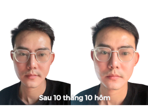 Alternative view of Sau Cấy Tóc Tự Thân 11 Tháng – Phiên 1 (2000 Nang)