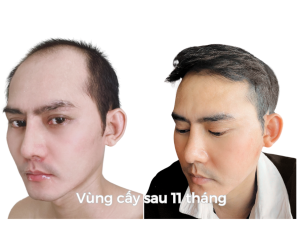 Sau Cấy Tóc Tự Thân 11 Tháng – Phiên 1 (2000 Nang)
