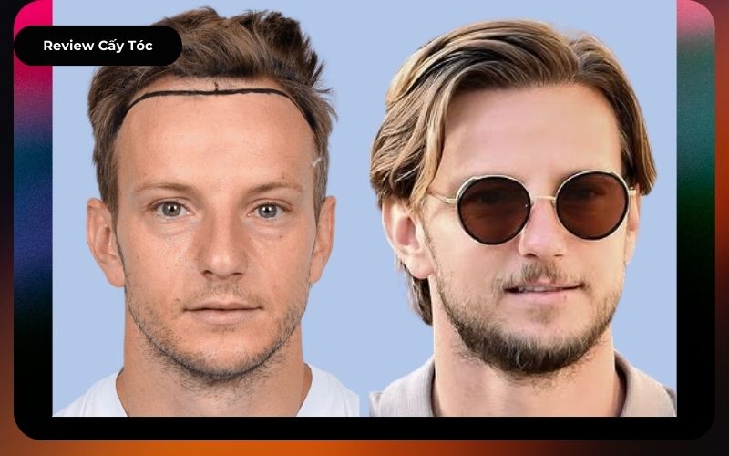 Review Cầu Thủ Ivan Rakitic trước và sau cấy tóc tự thân