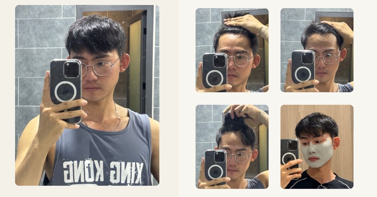 1 NĂM SAU CẤY TÓC TỰ THÂN CHỮA HÓI