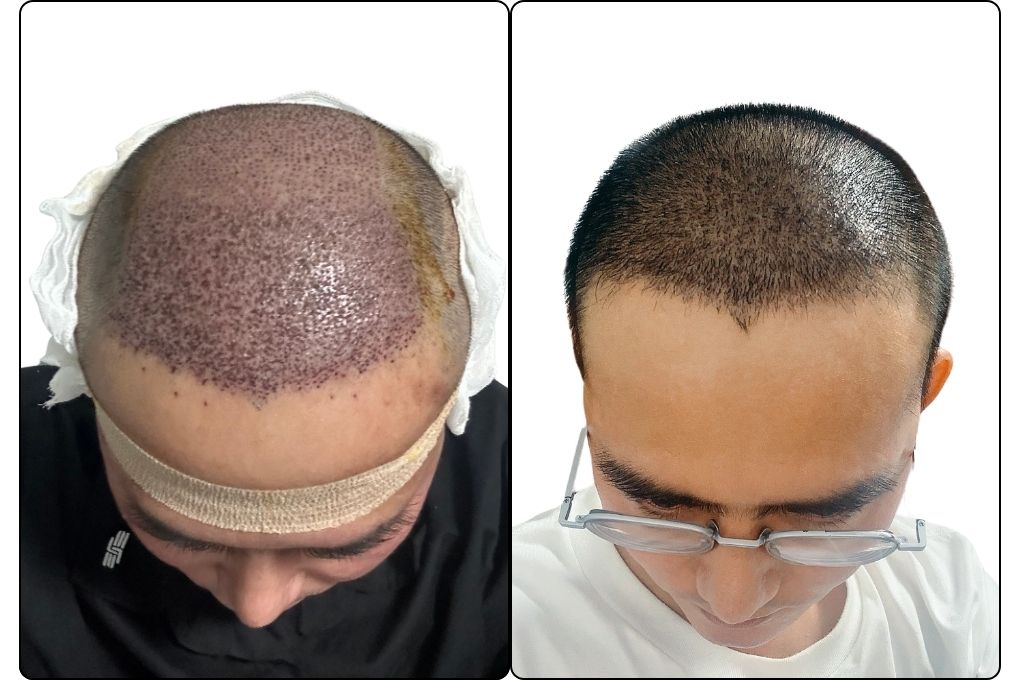 sau cấy tóc tự thân bằng công nghệ cấy DHI trị hói thành công 2 tuần của cậu bé thoát hói