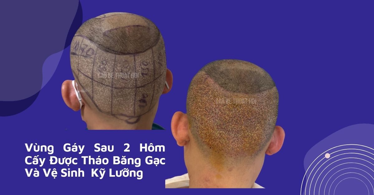sau cấy tóc tự thân bằng công nghệ cấy DHI trị hói thành công 2 hôm của cậu bé thoát hói