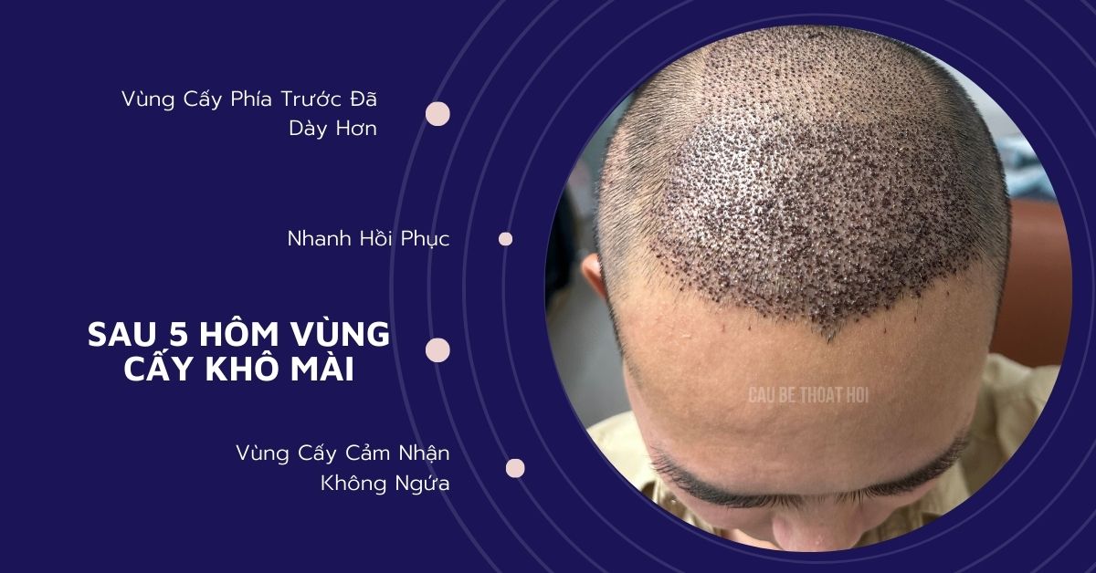 sau cấy tóc tự thân bằng công nghệ cấy DHI trị hói thành công 5 hôm của cậu bé thoát hói