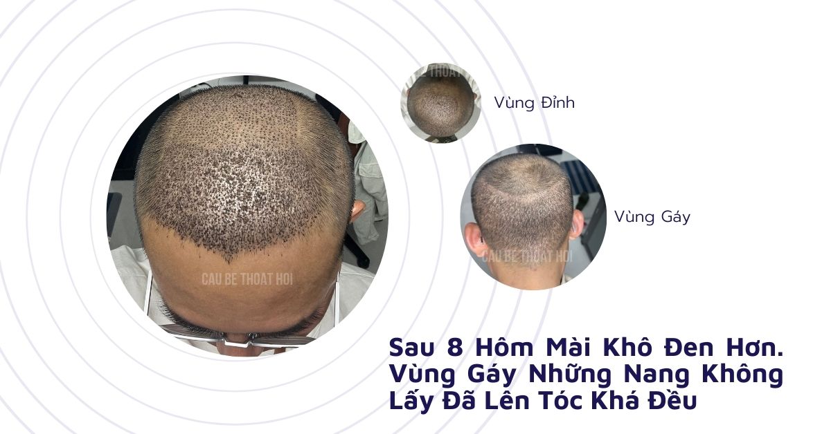 sau cấy tóc tự thân bằng công nghệ cấy DHI trị hói thành công 8 hôm của cậu bé thoát hói