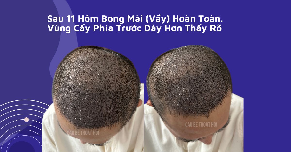 sau cấy tóc tự thân bằng công nghệ cấy DHI trị hói thành công 11 hôm của cậu bé thoát hói