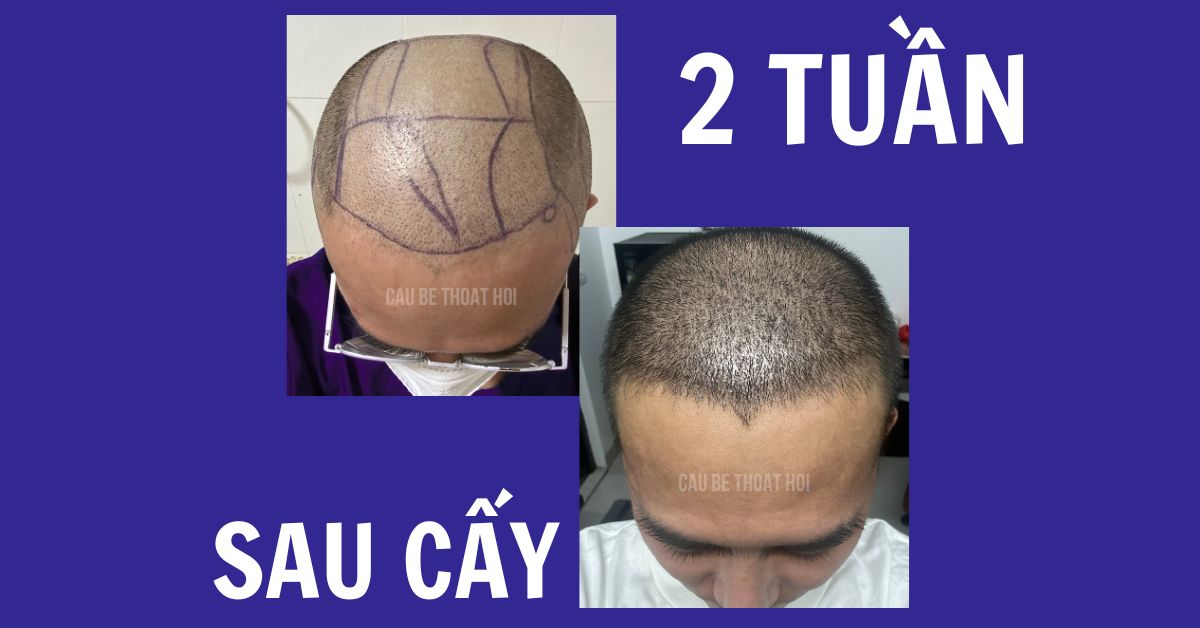 sau cấy tóc tự thân bằng công nghệ cấy DHI trị hói thành công 2 tuần của cậu bé thoát hói