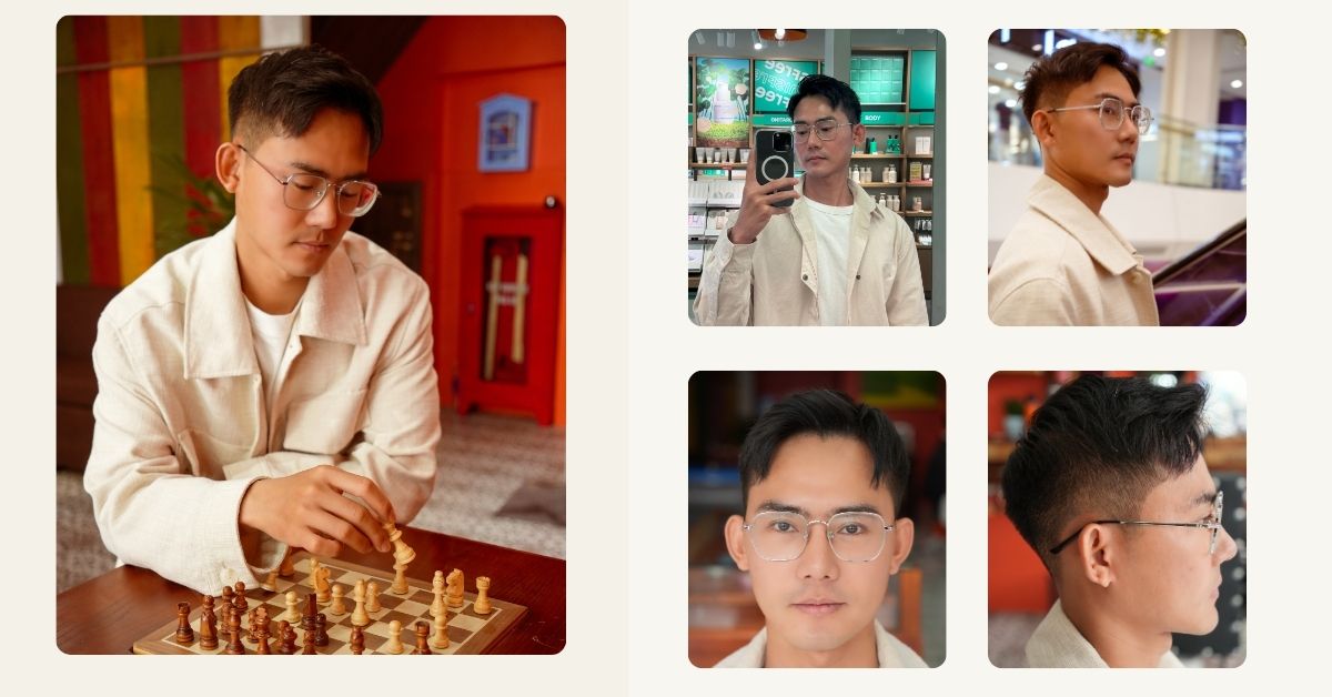 11 THÁNG SAU CẤY TÓC CHỮA HÓI THÀNH CÔNG CỦA CẬU BÉ THOÁT HÓI