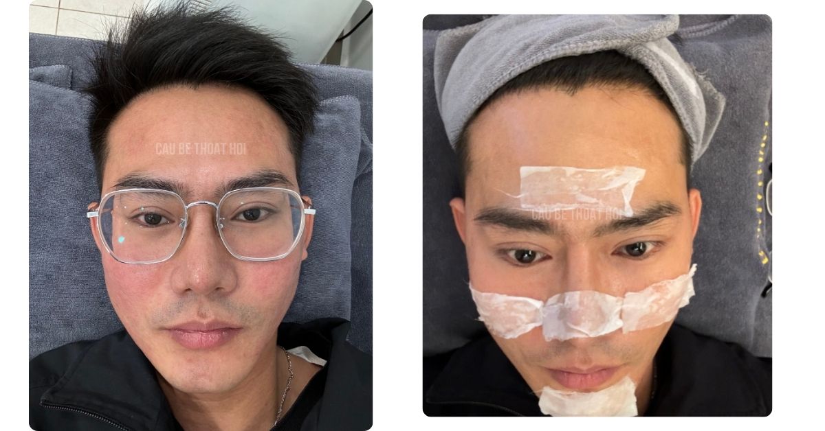 SAU CẤY TÓC THÀNH CÔNG MÌNH TỰ TIN ĐI CLINIC CHĂM DA