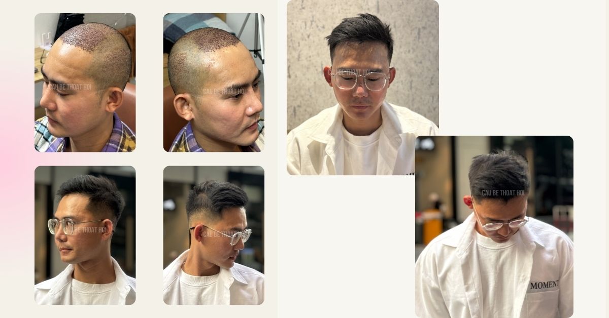 KẾT QUẢ 7 THÁNG 10 HÔM SAU CẤY TÓC TRỊ HÓI ĐẦU THÀNH CÔNG