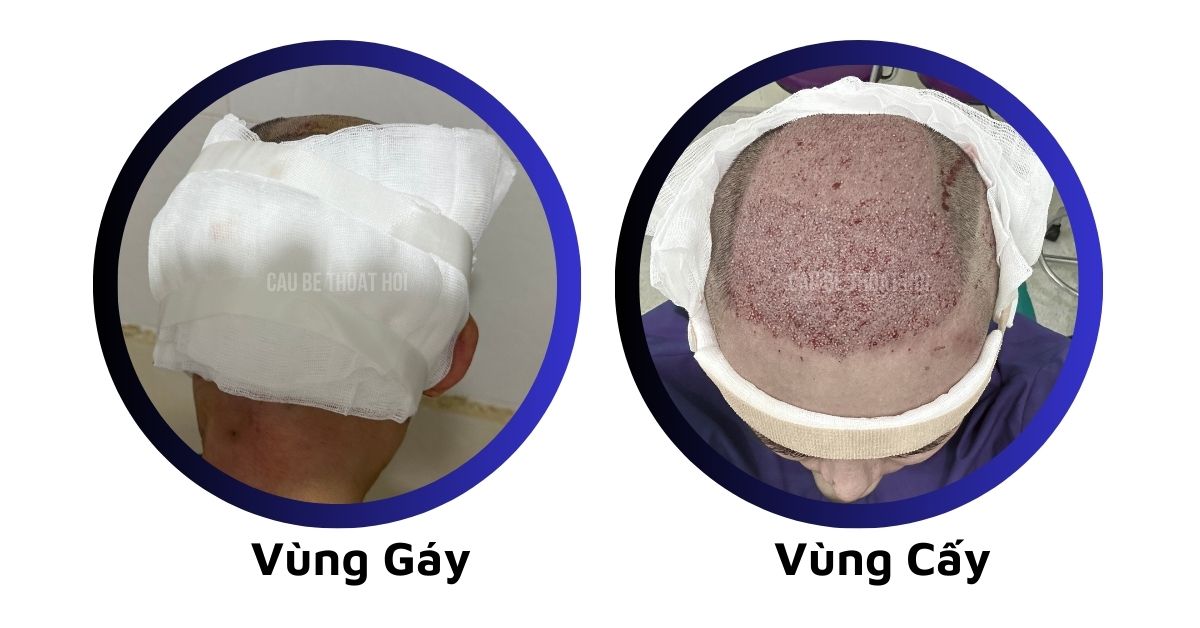 sau cấy tóc tự thân bằng công nghệ cấy DHI trị hói thành công của cậu bé thoát hói