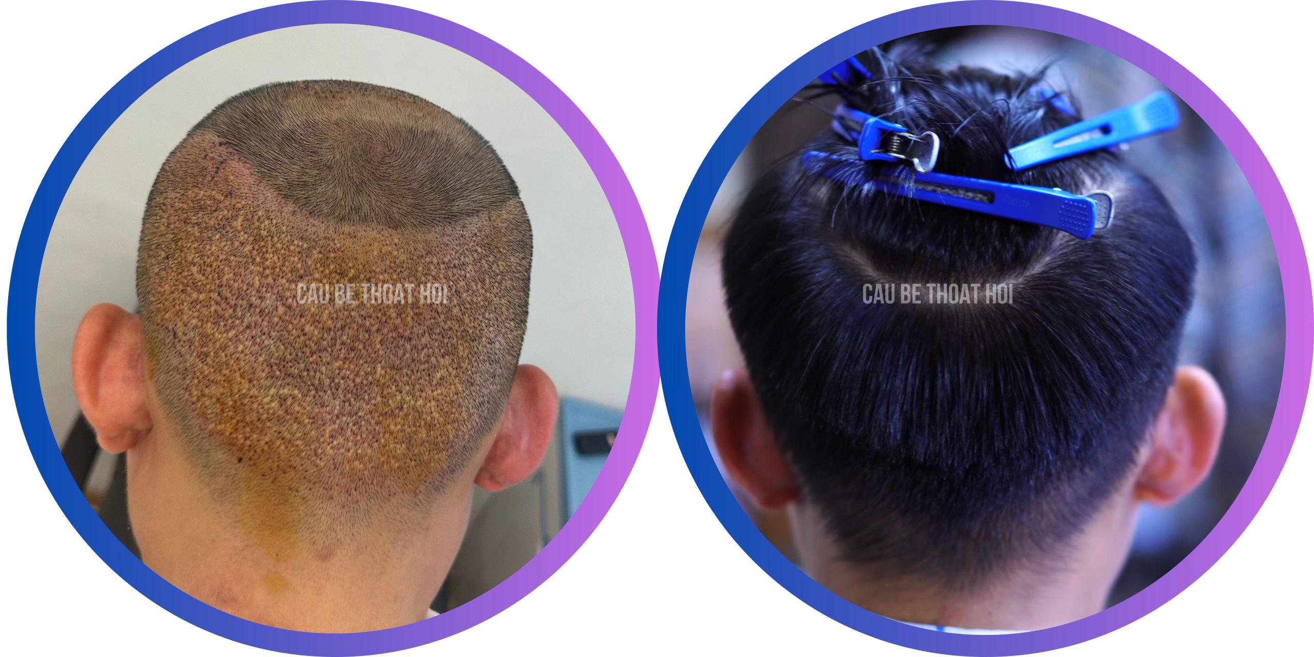 KẾT QUẢ SAU CẤY TÓC CHỮA HÓI 9 THÁNG CÔNG NGHỆ CẤY TÓC DHI