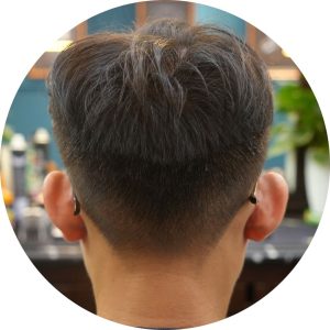 VÙNG HIẾN NANG SAU KHI NHỔ NANG KHI CẤY TÓC CHỮA HÓI