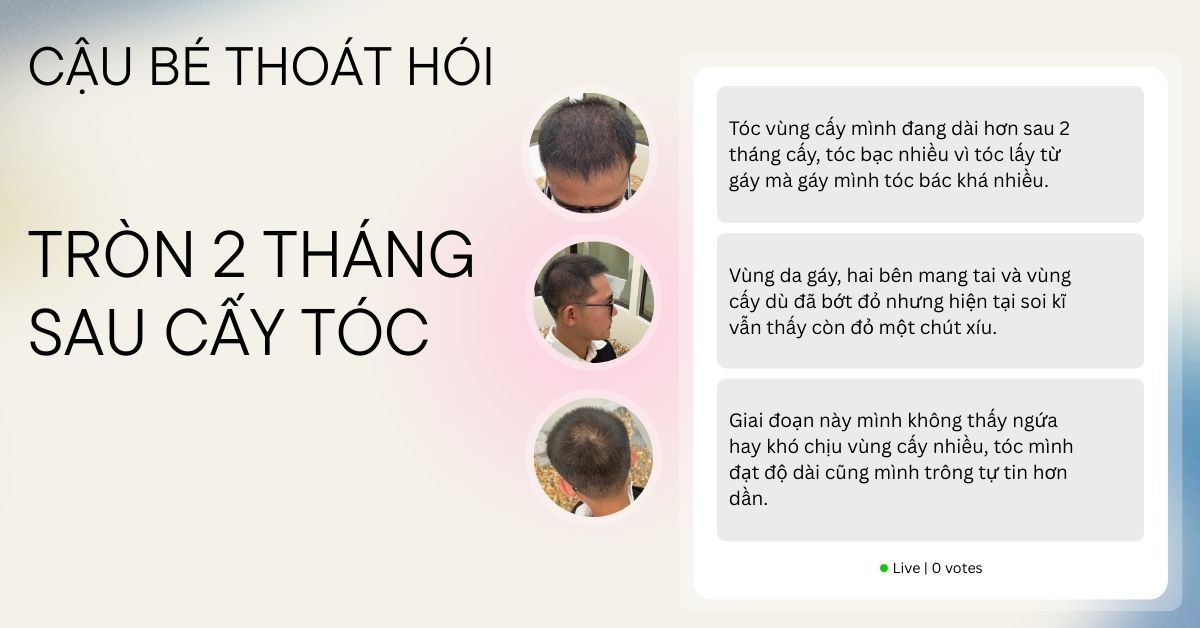 1 THÁNG 24 HÔM SAU TRỊ HÓI CẤY TÓC MÌNH QUYẾT ĐỊNH ĐI CẮT TÓC CHO GỌN GÀNG HƠN