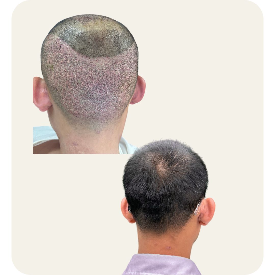 2 THÁNG 11 HÔM SAU CẤY TÓC BẰNG PHƯƠNG PHÁP BÚT CẤY DHI. VÙNG GÁY HIẾN NANG VẪN ĐỀU DÀY, KHÔNG LỘ DẤU VẾT BẤT THƯỜNG SAU KHI TÓC MỌC LÊN CHO DÙ MÌNH LẤY 5100 NANG TÓC.