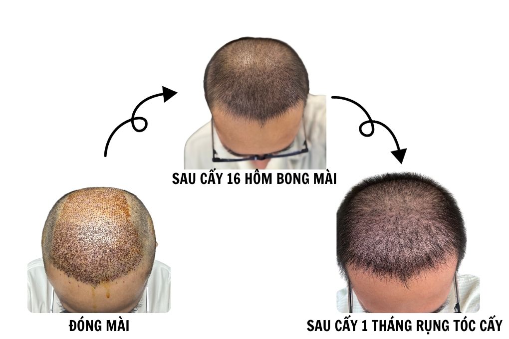 sau cấy tóc chữa hói thành công 1 tháng cậu bé thoát hói bằng công nghệ cấy tóc DHI