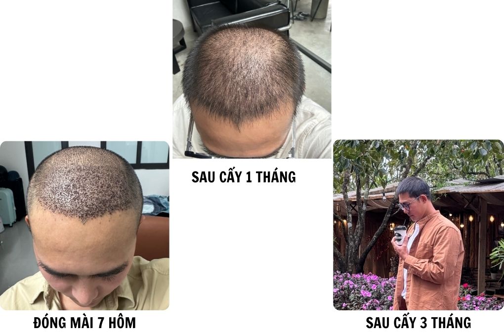 hành trình 3 tháng cấy tóc chữa hói cậu bé thoát hói