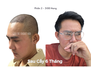 Sau Cấy Tóc Tự Thân 6 Tháng - Phiên 2 (3100 Nang)