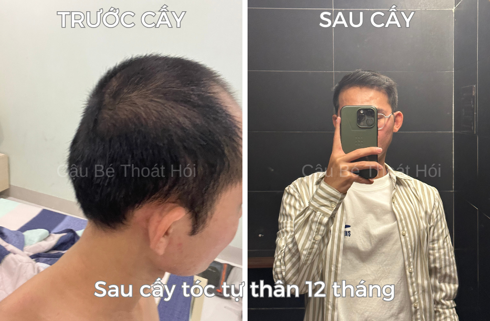 Sau 12 tháng cấy tóc tự thân chữa hói công nghệ cấy tóc DHI của cậu bé thoát hói