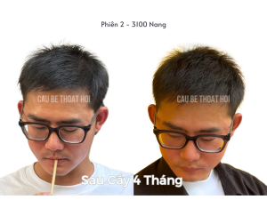 Alternative view of Sau Cấy Tóc Tự Thân 6 Tháng - Phiên 2 (3100 Nang)