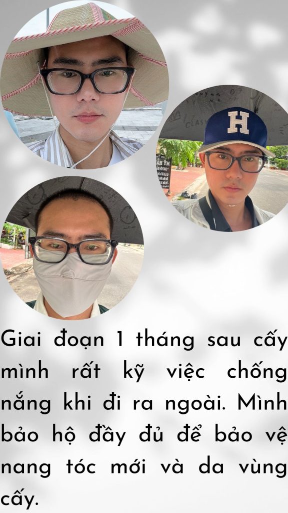 CHĂM SÓC HẬU PHẪU VÙNG CẤY TÓC SAU 1 THÁNG TRỊ HÓI