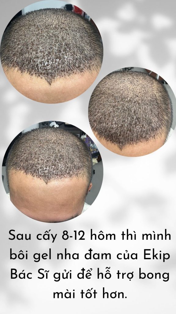 sau cấy tóc DHI bác sĩ cho mình gel nha đam để bôi vào vùng cấy hỗ trợ bong vẩy 