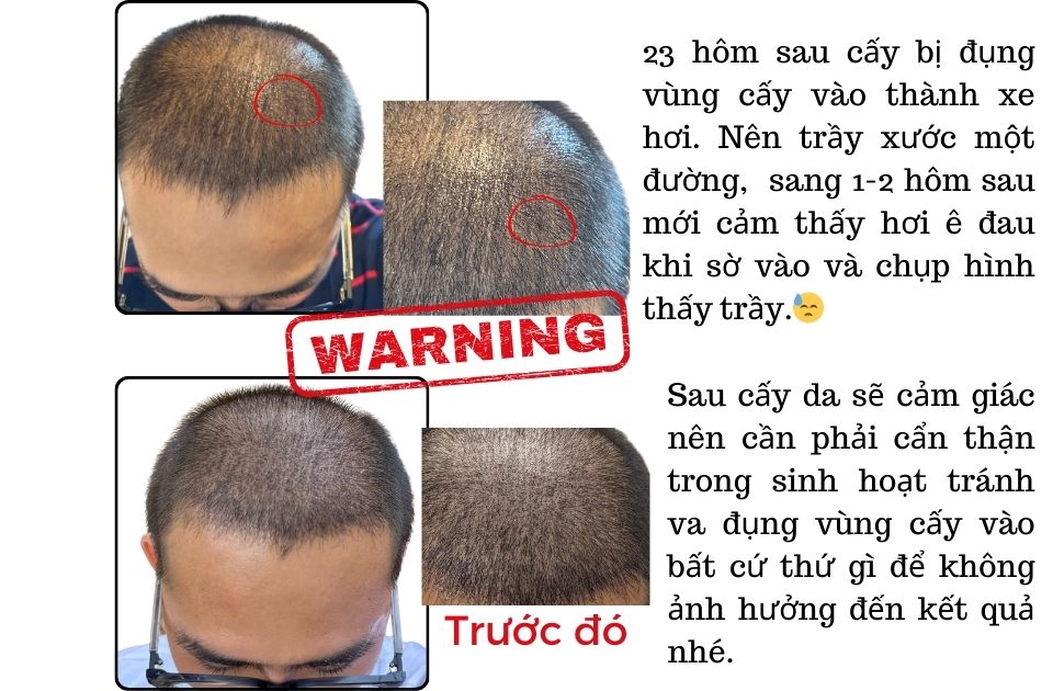 SỰ CỐ VA CHẠM VÙNG DA CẤY TÓC VÀO THÀNH XE HƠI NÊN BỊ TRẦY XƯỚC SAU CẤY TÓC TRỊ HÓI.