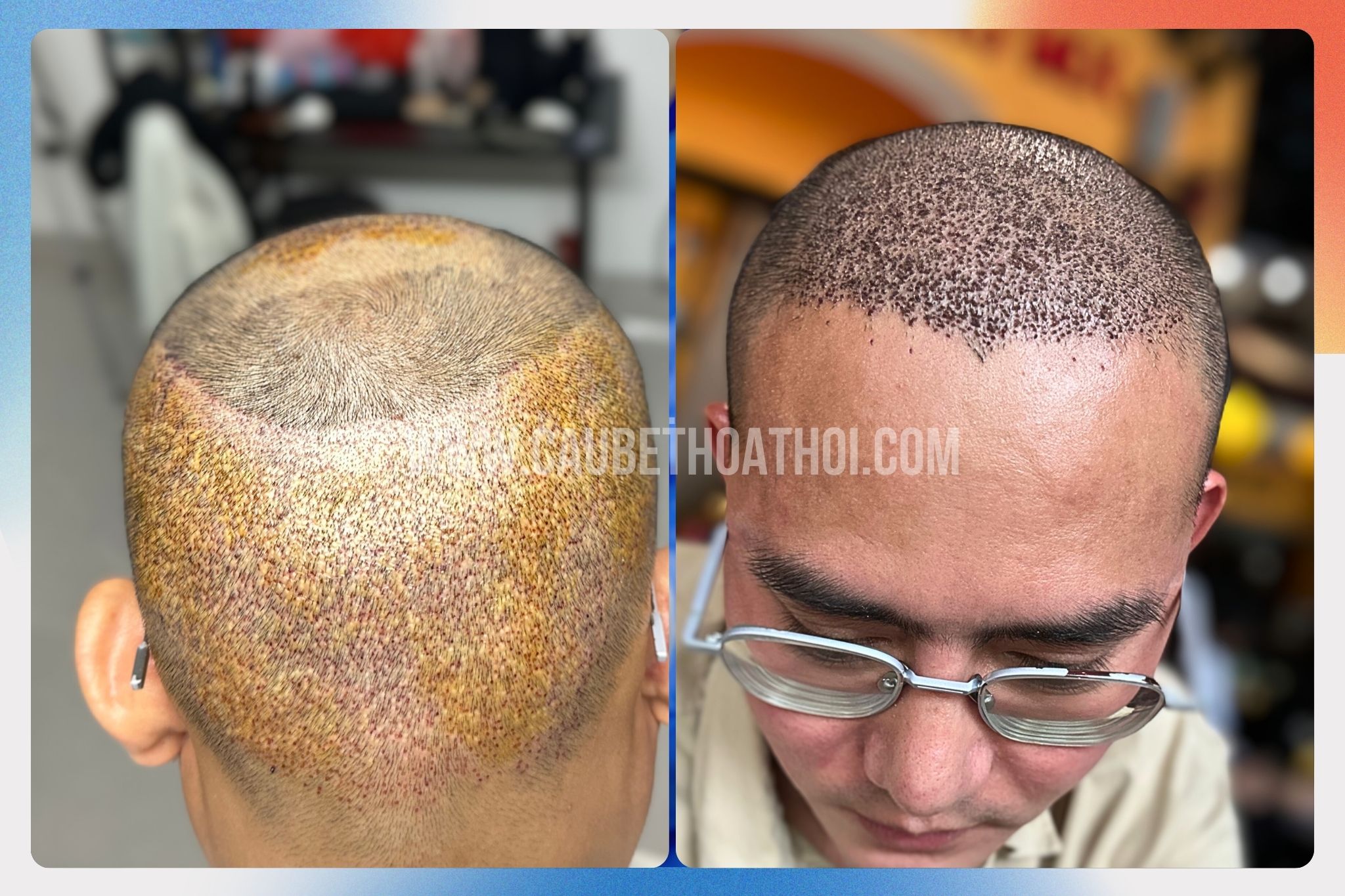 BANNER TRANG CHỦ CẬU BÉ THOÁT HÓI THÀNH CÔNG SAU CẤY TÓC