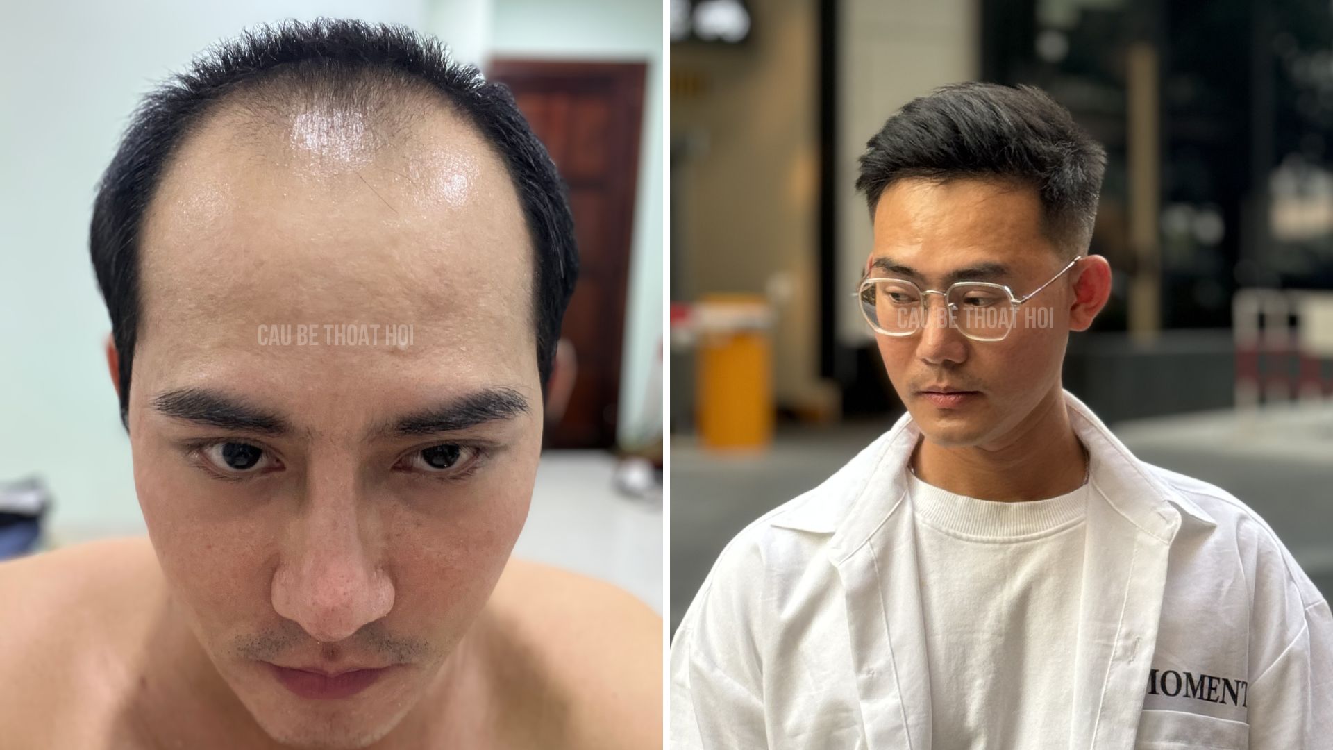 BANNER TRANG CHỦ CẬU BÉ THOÁT HÓI THÀNH CÔNG SAU CẤY TÓC