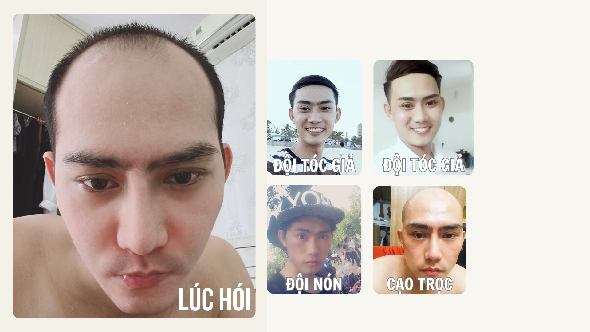 BANNER TRANG CHỦ CẬU BÉ THOÁT HÓI THÀNH CÔNG SAU CẤY TÓC