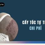 Chi Phí Cấy Tóc Có Giá Bao Nhiêu