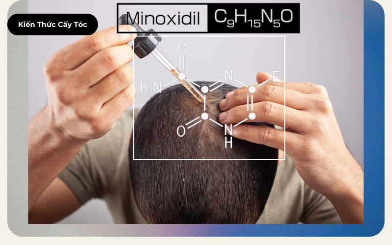 Minoxidil (Rogaine) Điều Trị Chứng Rụng Tóc Androgen - CẬU BÉ THOÁT HÓI