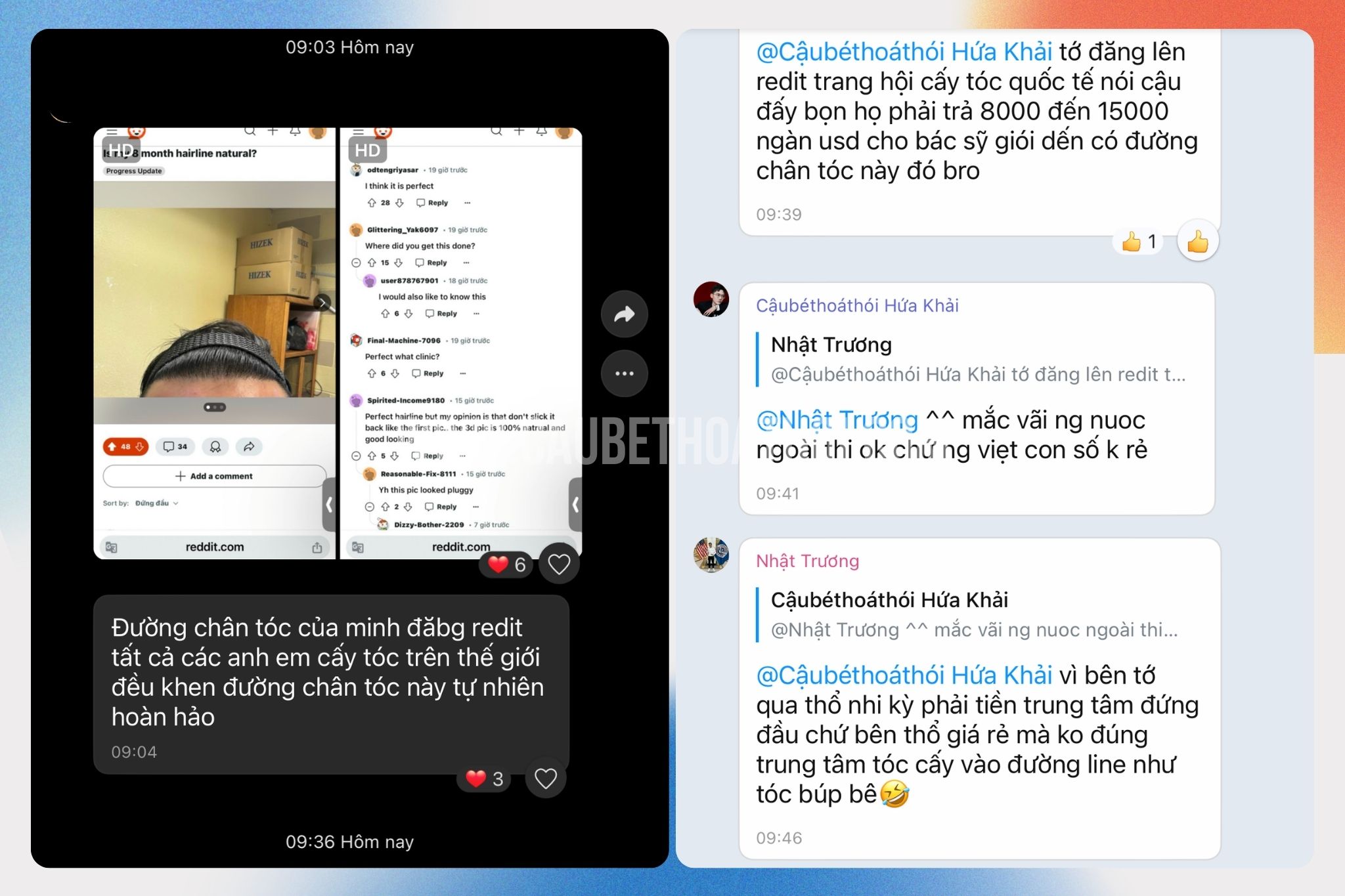 Nhật trương khoe kết quả sau cấy tóc tự thân thành công