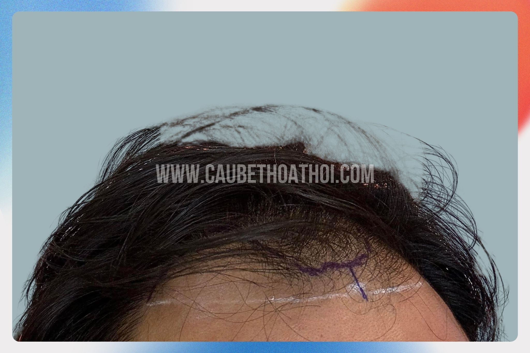 Nhật trương trước cấy tóc tự thân (1)