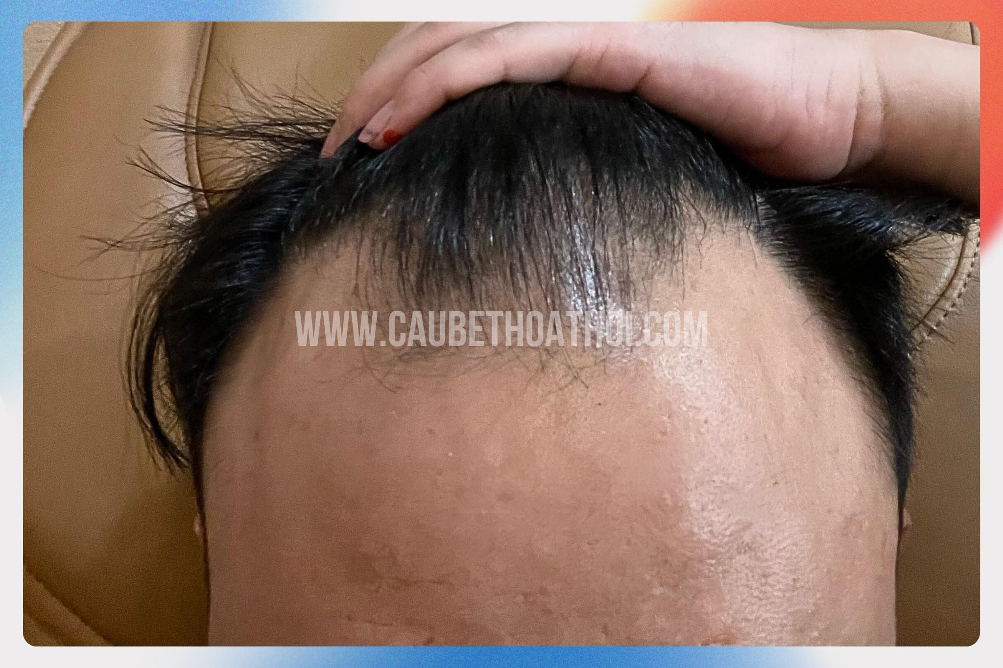 Nhật trương trước cấy tóc tự thân