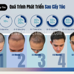 Quá Trình Phát Triển Sau Cấy Tóc Bạn Nên Biết