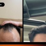 Review Chàng Việt Kiều Mỹ Về Việt Nam Cấy Tóc & Kết Quả