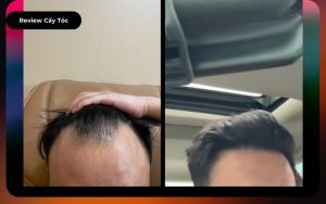 Review Chàng Việt Kiều Mỹ Về Việt Nam Cấy Tóc & Kết Quả
