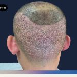 Vùng Hiến Tặng Tóc Để Cấy Tóc Mọi Thứ Bạn Cần Biết